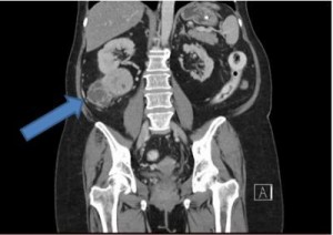 This is a CT scan with arrow indicating kidney tumor. (Photo Credit: IBN)
