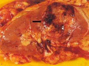 This is a nephrectomy specimen showing a renal cell carcinoma composed of a tumor mass with yellowish and hemorrhagic areas (arrow). (Photo Credit: IBN)