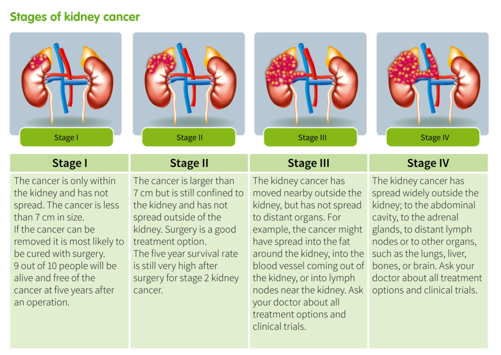 What Are The Different Kidney Cancer Stages Ikcc International Kidney Cancer Coalition