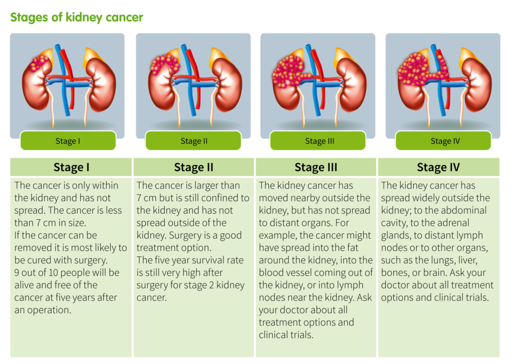 ما هي مراحل سرطان الكلى المختلفة Ikcc International Kidney Cancer Coalition